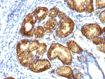 MUC6 / MUC-6 Antibody - Formalin-fixed, paraffin-embedded human gastric carcinoma stained with MUC6 antibody (CLH5).  This image was taken for the unmodified form of this product. Other forms have not been tested.
