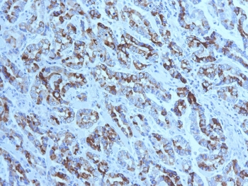 MUC6 / MUC-6 Antibody - IHC testing of FFPE gastric carcinoma with MUC6 antibody (clone CLH5). HIER: steam section in pH6 citrate buffer for 20 min and allow to cool prior to tetsting.