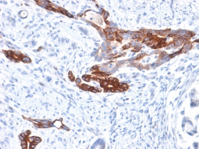 MUC6 / MUC-6 Antibody - Formalin-fixed, paraffin-embedded human Gastric Carcinoma stained with MUC6 Rabbit Recombinant Monoclonal Antibody (MUC6/1553R).