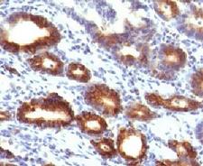MUC6 / MUC-6 Antibody - IHC testing of FFPE human gastric carcinoma with Mucin-6 antibody (clone MUCN6-1).  This image was taken for the unmodified form of this product. Other forms have not been tested.
