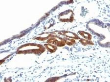 MUC6 / MUC-6 Antibody - Formalin-fixed, paraffin-embedded human gastric carcinoma stained with anti-MUC6 antibody (SPM598).  This image was taken for the unmodified form of this product. Other forms have not been tested.
