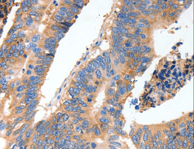 MUC6 / MUC-6 Antibody - Immunohistochemistry of paraffin-embedded Human thyroid cancer using MUC6 Polyclonal Antibody at dilution of 1:40.