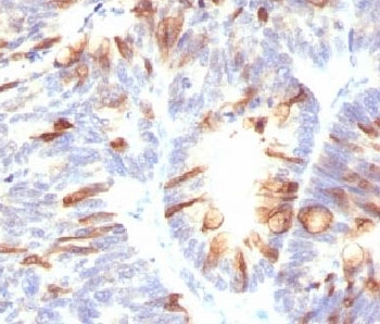 Mucin 2 / MUC2 Antibody - IHC testing of FFPE human colon carcinoma with MUC2 antibody