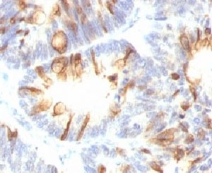 Mucin 2 / MUC2 Antibody - Formalin-fixed, paraffin-embedded human colon carcinoma stained with MUC2 antibody (MLP/842).  This image was taken for the unmodified form of this product. Other forms have not been tested.