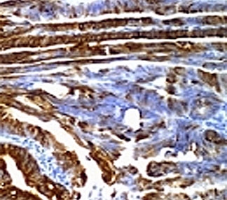 Mucin 2 / MUC2 Antibody - Formalin-fixed, paraffin-embedded human colon carcinoma stained with MUC2 antibody (SPM296).  This image was taken for the unmodified form of this product. Other forms have not been tested.