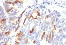 Mucin 2 / MUC2 Antibody - Formalin-fixed, paraffin-embedded human colon carcinoma stained with Mucin-2 antibody (SPM513).  This image was taken for the unmodified form of this product. Other forms have not been tested.