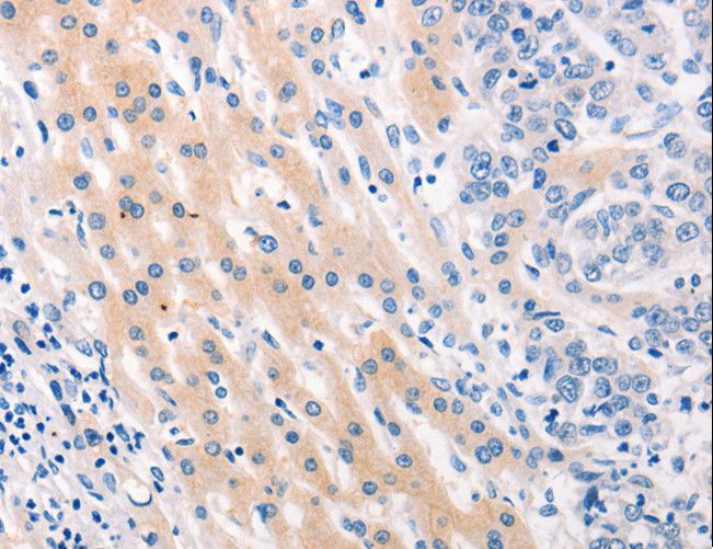 Mucin 2 / MUC2 Antibody - Immunohistochemistry of paraffin-embedded Human liver cancer using MUC2 Polyclonal Antibody at dilution of 1:60.