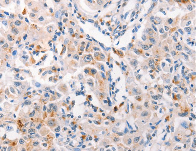 Mucin 2 / MUC2 Antibody - Immunohistochemistry of paraffin-embedded Human liver cancer using MUC2 Polyclonal Antibody at dilution of 1:60.