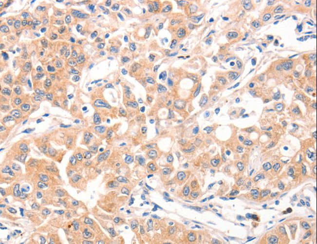 Mucin 2 / MUC2 Antibody - Immunohistochemistry of paraffin-embedded Human lung cancer using MUC2 Polyclonal Antibody at dilution of 1:60.