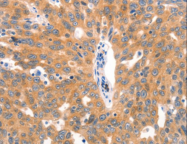 Mucin 2 / MUC2 Antibody - Immunohistochemistry of paraffin-embedded Human lung cancer using MUC2 Polyclonal Antibody at dilution of 1:60.