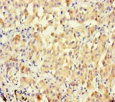 MUCL1 Antibody - Immunohistochemistry of paraffin-embedded human lung cancer using BPESC1 Antibody at dilution of 1:100