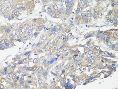 MUL1 / MULAN Antibody - Immunohistochemistry of paraffin-embedded human liver cancer using MUL1 antibody at dilution of 1:100 (40x lens).
