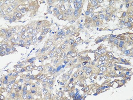 MUL1 / MULAN Antibody - Immunohistochemistry of paraffin-embedded Human liver cancer using MUL1 Polyclonal Antibody at dilution of 1:100 (40x lens).