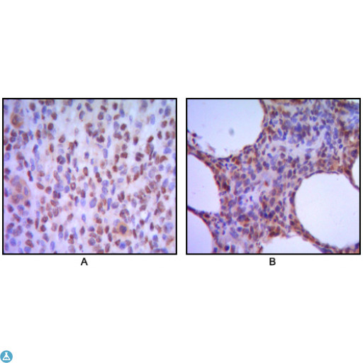 MUM1 Antibody - Immunohistochemistry (IHC) analysis of paraffin-embedded human melanoma (A), non-Hodgkin`s lymphoma (B), with DAB staining using MUM1 Monoclonal Antibody.