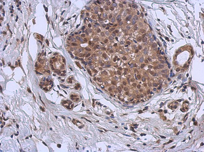 MURF1 / IRF Antibody - IHC of paraffin-embedded Breast ca using MURF1 antibody at 1:500 dilution.