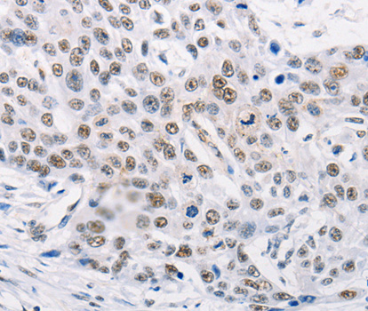 MURF1 / IRF Antibody - Immunohistochemistry of paraffin-embedded human esophagus cancer tissue.
