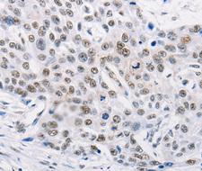 MURF1 / IRF Antibody - Immunohistochemistry of paraffin-embedded human esophagus cancer tissue.