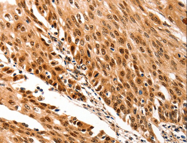 MURF1 / IRF Antibody - Immunohistochemistry of paraffin-embedded Human cervical cancer using TRIM63 Polyclonal Antibody at dilution of 1:70.