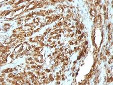 Muscle Actin Antibody - Formalin-fixed, paraffin-embedded human rhabdomyosarcoma stained with pan Muscle Actin antibody (HHF35 + MSA/953).  This image was taken for the unmodified form of this product. Other forms have not been tested.