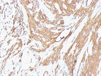 Muscle Actin Antibody - Formalin-fixed, paraffin-embedded human leiomyosarcoma stained with pan Muscle Actin antibody.  This image was taken for the unmodified form of this product. Other forms have not been tested.
