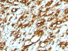 Muscle Actin Antibody - Formalin-fixed, paraffin-embedded human rhabdomyosarcoma stained with pan Muscle Actin antibody (MSA/953).  This image was taken for the unmodified form of this product. Other forms have not been tested.