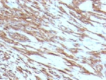 Muscle Actin Antibody - Formalin-fixed, paraffin-embedded human leiomyosarcoma stained with pan Muscle Actin antibody (MSA/953).  This image was taken for the unmodified form of this product. Other forms have not been tested.