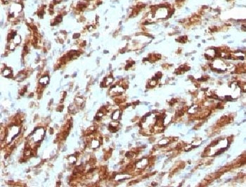 Muscle Actin Antibody - IHC testing of FFPE human rhabdomyosarcoma with Muscle Actin antibody (clone PMAC1-1).  This image was taken for the unmodified form of this product. Other forms have not been tested.