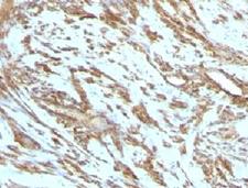 Muscle Actin Antibody - IHC testing of FFPE human leiomyosarcoma with Muscle Actin antibody (clone PMAC1-1).  This image was taken for the unmodified form of this product. Other forms have not been tested.