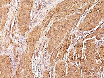 Muscle Actin Antibody - Formalin-fixed, paraffin-embedded human Leiomyosarcoma stained with Muscle Specific Actin antibody (SPM160).  This image was taken for the unmodified form of this product. Other forms have not been tested.