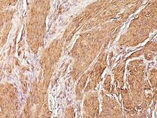 Muscle Actin Antibody - Formalin-fixed, paraffin-embedded human Leiomyosarcoma stained with Muscle Specific Actin antibody (SPM160).  This image was taken for the unmodified form of this product. Other forms have not been tested.