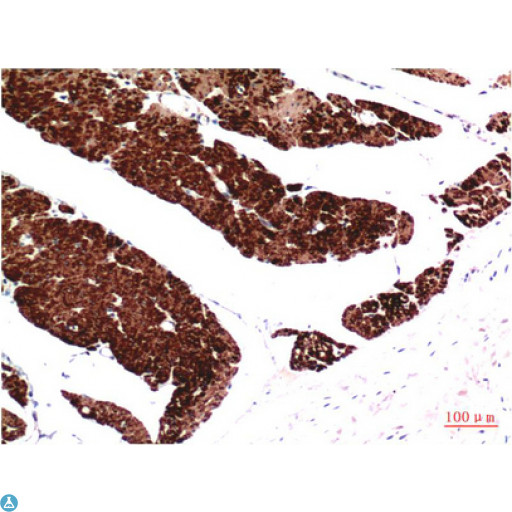 Muscle Actin Antibody - Immunohistochemistry (IHC) analysis of paraffin-embedded Human Colon Carcinoma Tissue using Muscle Actin Mouse Monoclonal Antibody diluted at 1:200.