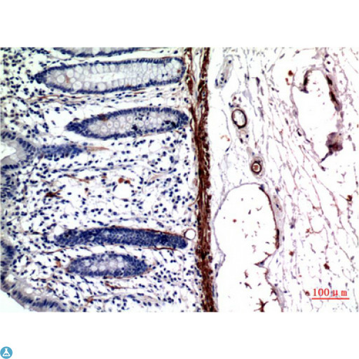 Muscle Actin Antibody - Immunohistochemistry (IHC) analysis of paraffin-embedded Human Colon CarcinomaTissue using Muscle Actin Mouse Monoclonal Antibody diluted at 1:200.