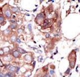 MUSK Antibody - Formalin-fixed and paraffin-embedded human cancer tissue reacted with the primary antibody, which was peroxidase-conjugated to the secondary antibody, followed by AEC staining. This data demonstrates the use of this antibody for immunohistochemistry; clinical relevance has not been evaluated. BC = breast carcinoma; HC = hepatocarcinoma.