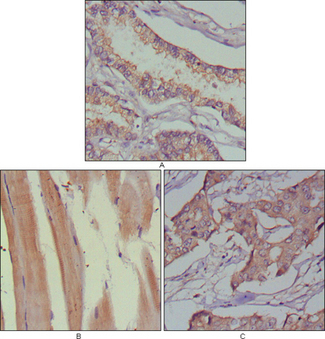 MUSK Antibody - IHC of paraffin-embedded human lung cancer (A), muscles (B) and breast cancer (C) using MUSK mouse monoclonal antibody with DAB staining.