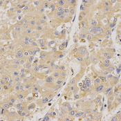 MUSK Antibody - Immunohistochemistry of paraffin-embedded human liver cancer using MUSK antibody at dilution of 1:200 (x400 lens).
