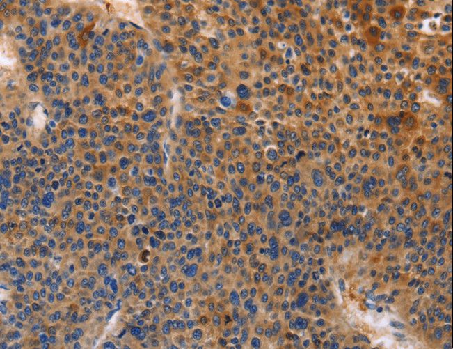 MUSK Antibody - Immunohistochemistry of paraffin-embedded Human cervical cancer using MUSK Polyclonal Antibody at dilution of 1:30.