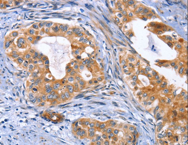 MUSK Antibody - Immunohistochemistry of paraffin-embedded Human cervical cancer using MUSK Polyclonal Antibody at dilution of 1:30.