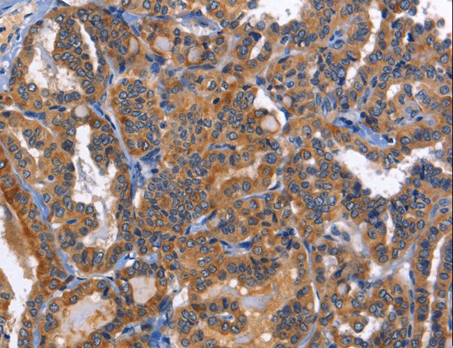 MUSK Antibody - Immunohistochemistry of paraffin-embedded Human liver cancer using MUSK Polyclonal Antibody at dilution of 1:40.