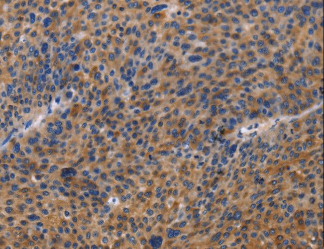 MUSK Antibody - Immunohistochemistry of paraffin-embedded Human liver cancer using MUSK Polyclonal Antibody at dilution of 1:40.