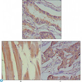 MUSK Antibody - Immunohistochemistry (IHC) analysis of paraffin-embedded human lung cancer (A), muscles (B) and breast cancer (C) with DAB staining, using anti-MuSK monoclonal Antibody (STJ98259).