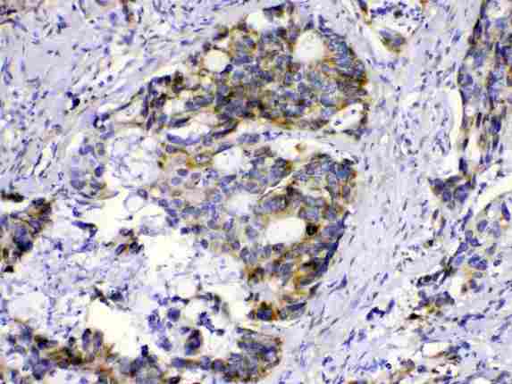 MUT / MCM Antibody - MUT was detected in paraffin-embedded sections of human intetsinal cancer tissues using rabbit anti-MUT Antigen Affinity purified polyclonal antibody at 1 µg/mL. The immunohistochemical section was developed using SABC method