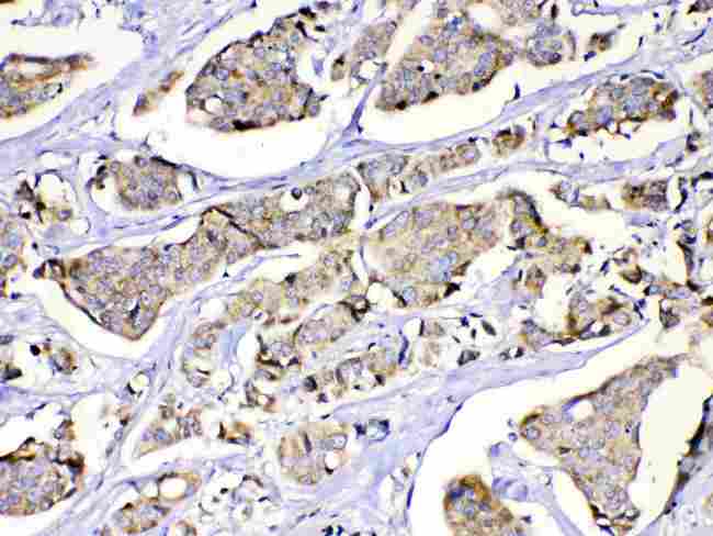 MUT / MCM Antibody - MUT was detected in paraffin-embedded sections of human lung cancer tissues using rabbit anti-MUT Antigen Affinity purified polyclonal antibody at 1 µg/mL. The immunohistochemical section was developed using SABC method