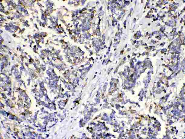 MUT / MCM Antibody - MUT was detected in paraffin-embedded sections of human mammary cancer tissues using rabbit anti-MUT Antigen Affinity purified polyclonal antibody at 1 µg/mL. The immunohistochemical section was developed using SABC method