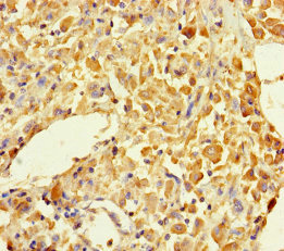 MUTED Antibody - Immunohistochemistry of paraffin-embedded human melanoma using BLOC1S5 Antibody at dilution of 1:100