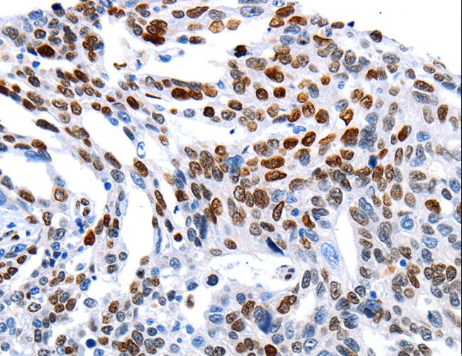 MUTYH / MYH Antibody - Immunohistochemistry of paraffin-embedded Human ovarian cancer using MUTYH Polyclonal Antibody at dilution of 1:60.