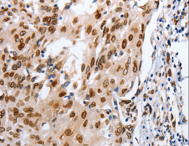 MUTYH / MYH Antibody - Immunohistochemistry of paraffin-embedded Human cervical cancer using MUTYH Polyclonal Antibody at dilution of 1:25.