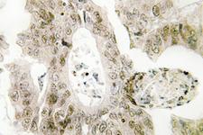MUTYH / MYH Antibody - IHC of MYH (Y176) pAb in paraffin-embedded human colon carcinoma tissue.