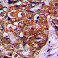 MVK Antibody - Immunohistochemical analysis of MVK staining in human breast cancer formalin fixed paraffin embedded tissue section. The section was pre-treated using heat mediated antigen retrieval with sodium citrate buffer (pH 6.0). The section was then incubated with the antibody at room temperature and detected with HRP and DAB as chromogen. The section was then counterstained with hematoxylin and mounted with DPX.