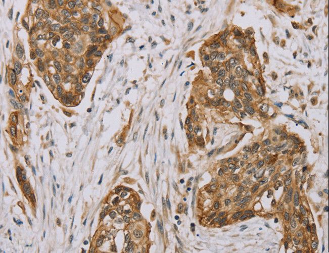 MVK Antibody - Immunohistochemistry of paraffin-embedded Human esophagus cancer using MVK Polyclonal Antibody at dilution of 1:40.