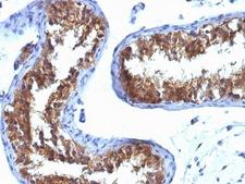 MVP / VAULT1 Antibody - Formalin-fixed, paraffin-embedded human testicular carcinoma stained with Major Vault Protein antibody (1032).  This image was taken for the unmodified form of this product. Other forms have not been tested.